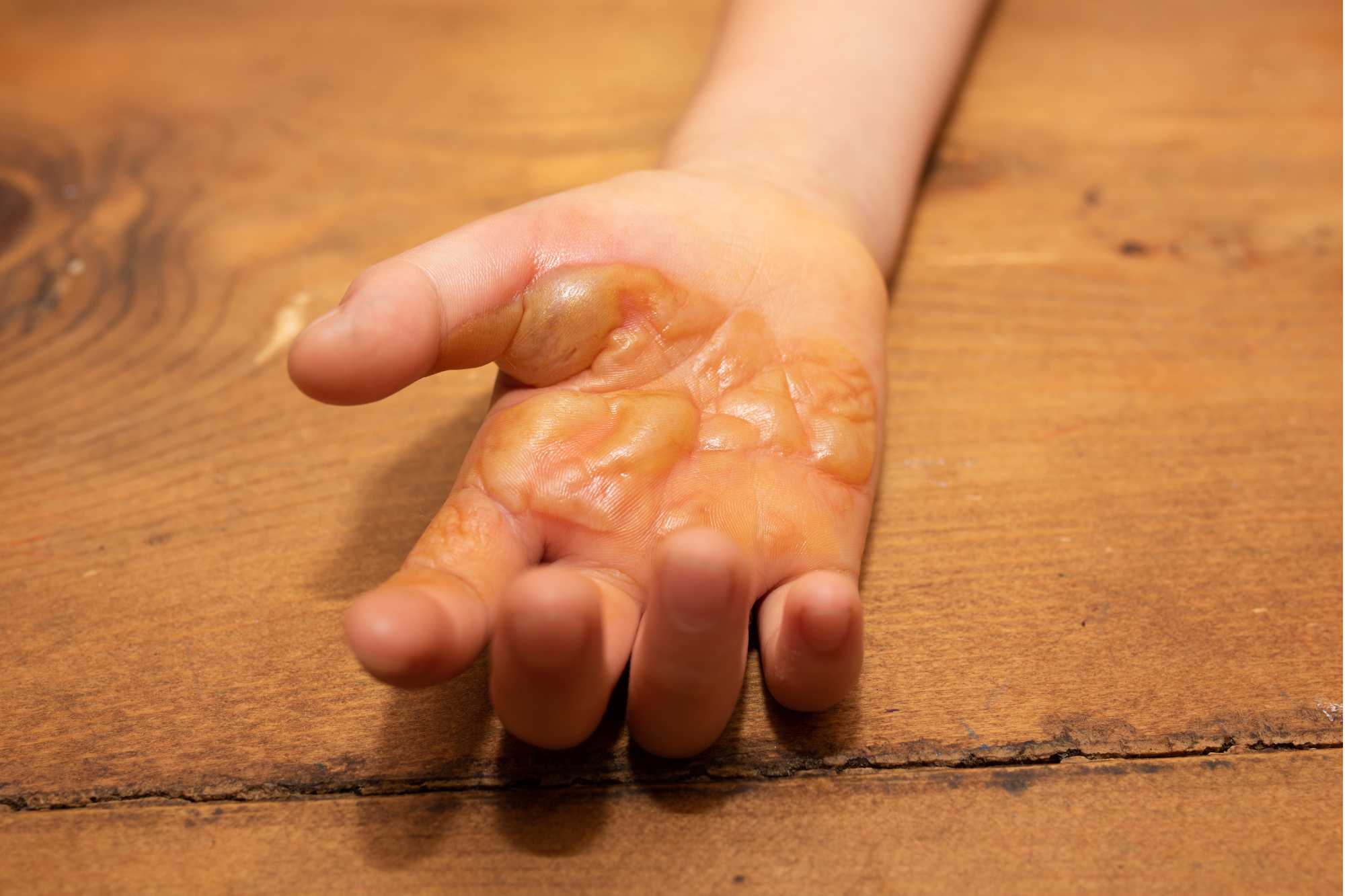 Popalená ruka s pľuzgiermi